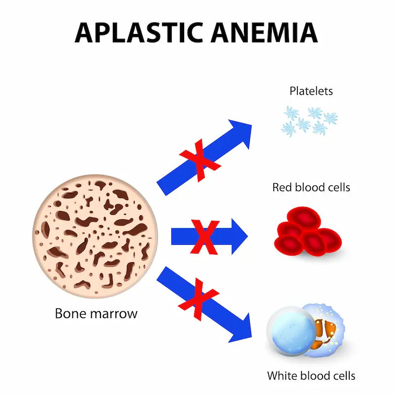 Aplastic Anaemia Symptoms, Causes, and Treatment